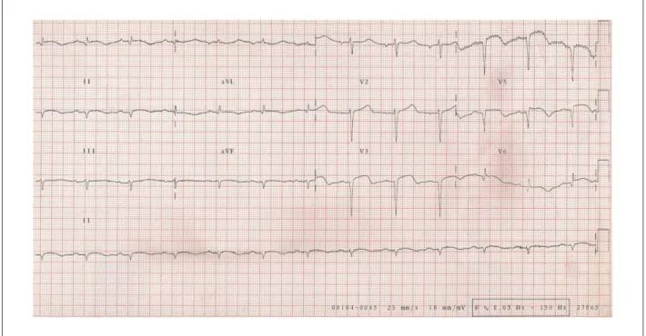 Figure 3 -  ECG. No alterations in comparison to the previous ones, extensive electrically inactive anterior area and probable electrically inactive area in the lower wall,  persistence of ST-segment elevation, suggesting aneurysm formation in the LV anter