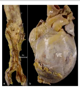 Figura 4 -  Imágenes macroscópicas de la aorta y vista frontal del corazón. 