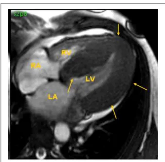 Figure 2 - Multiplane IOTEE of a patient with HCM; Figure 2A (prior to surgical correction), Figure 2B (after surgical correction)