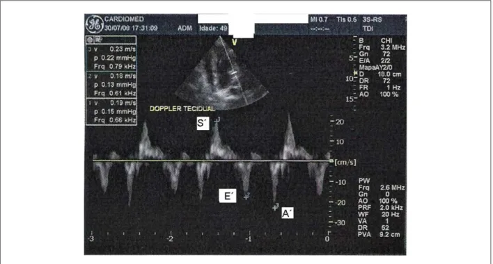 Table 3 - Correlation between systolic function evaluated in the  longitudinal axis (S’) with TDE and BNP variables