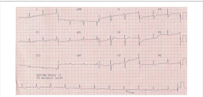 Fig. 1 - ECG: alterações de repolarização ventricular.