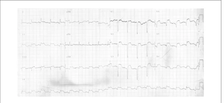 Fig. 3 - ECG: taquicardia sinusal, complexos QS (parede anterior) e persistência do supradesnivelamento de segmento ST.