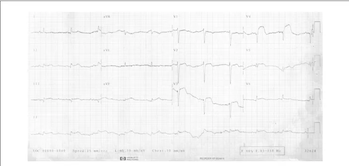 Figure 2 - ECG: Ongoing infarction in the anterior and inferior walls.