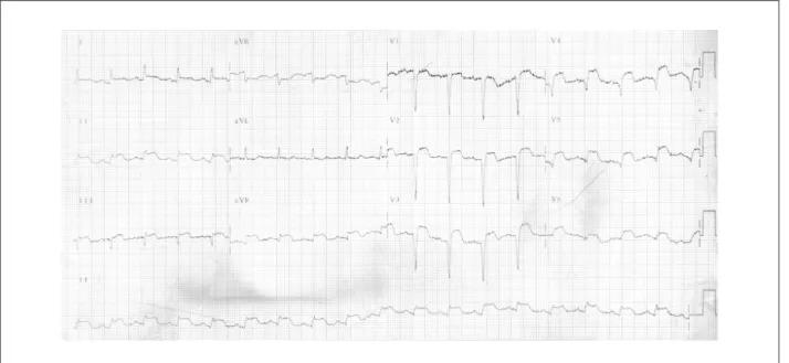 Figure 3 - ECG: sinus tachycardia, QS complexes (anterior wall) and persistence of ST-segment elevation.