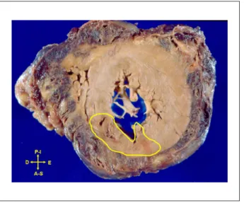 Figure 6 - Photomicrographs of the bypass graft in two segments. A- proximal segment with intimal thickening (artifactually enhanced intima); B- mid segment, with  recent, partially occlusive thrombosis