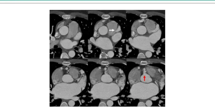 Figure 2 - Three-dimensional reconstruction by volume rendering of the coronary tree demonstrating dilatation and tortuosity of all vascular segments associated with  septal defect of the origin of the left main coronary artery into the aorta.