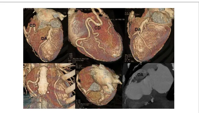 Figure 3 - Three-dimensional reconstruction by volume rendering associating the cardiac image and the coronary tree