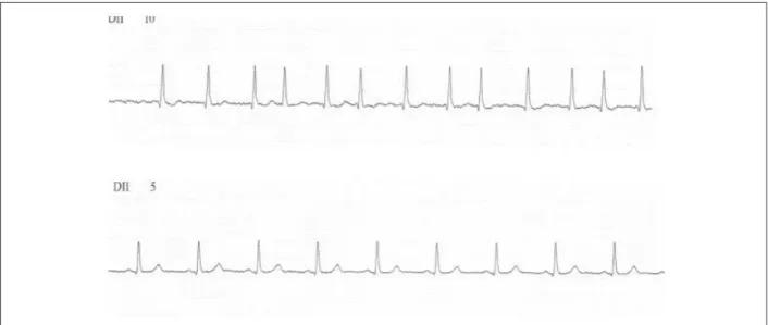 Figure 1 - Initial electrocardiogram showing atrial ibrillation (superior) and in sinus rhythm (inferior) after etiological treatment with benzonidazole.