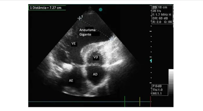 Figure 1 - A giant left ventricular aneurysm caused by a past extensive myocardial infarction