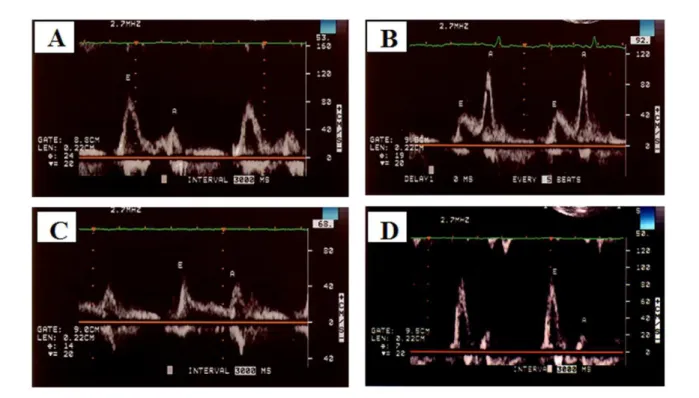 Figure 3 - Diastolic mitral transvalvular low recorded by pulsed Doppler in a normal individual (A) and in the presence of grade I (B), grade II (C) and grade III diastolic  dysfunction (D).