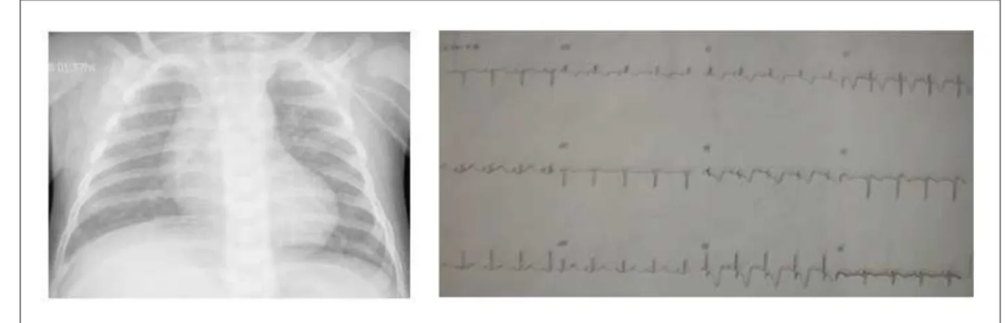 Fig. 2 - O ecocardiograma mostra a dilatação do ventrículo esquerdo em projeção de 4 câmaras em A e a fístula entre a artéria coronária esquerda e o tronco pulmonar  em corte supraesternal, em B.