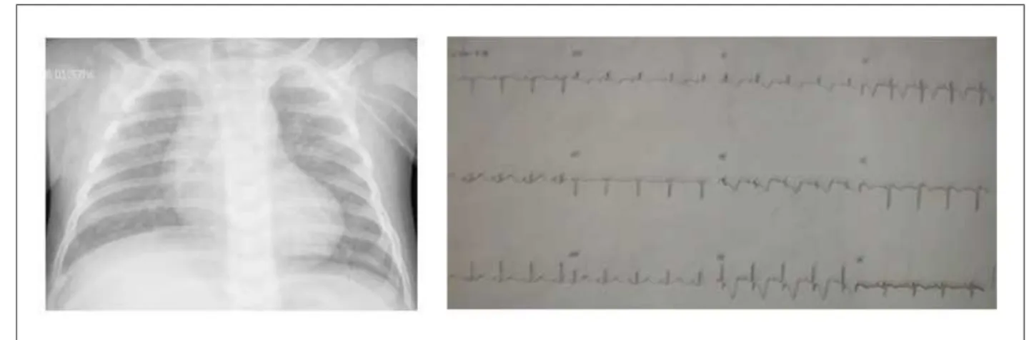 Figure 2 - The echocardiogram shows left ventricular dilation at the four-chamber view in A and the istula between the left coronary artery (LCA) and the pulmonary  trunk (PT) in the suprasternal view, in B.