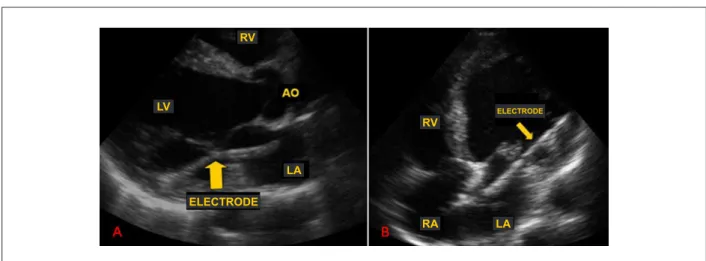 Figure 1 - (A) Parasternal longitudinal view of transthoracic echocardiogram showing the pacemaker electrode going past the mitral valve in the direction of the left  ventricular posterior wall