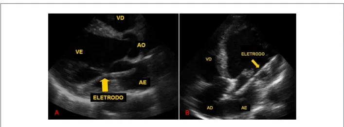Fig. 1 - (A) Corte paraesternal longitudinal de ecocardiograma transtorácico que demuestra electrodo de marcapaso sobrepasando la válvula mitral hacia la pared  posterior del ventrículo izquierdo