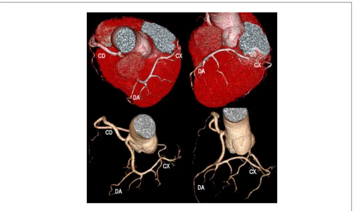 Fig 1 - Reconstrução tridimensional da anatomia coronária DA - descendente anterior, CX - circunlexa, CD - coronária direita.