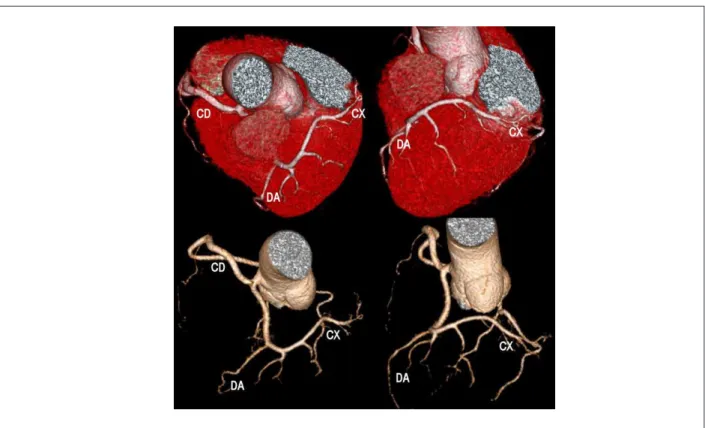 Fig 1 - Reconstrucción tridimensional de la anatomía coronaria. DA - descendente anterior, CX - circunleja, CD - coronaria derecha.
