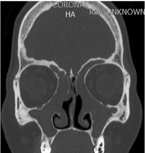 Figura 4 - Medialização da parede nasal lateral com 