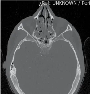 Figura 5 - Corte axial de TC de seios da face, 