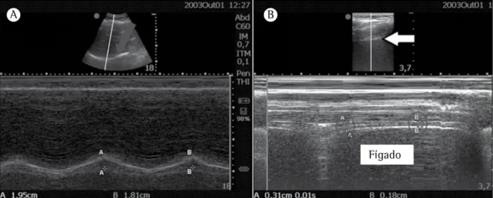 Figura 7 - Ultrassom diafragmático. Em A, ultrassom para estudo da mobilidade diafragmática