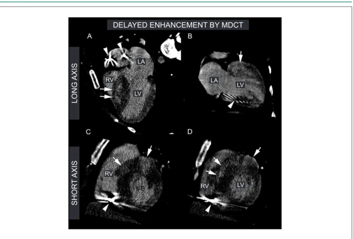 Figure 1 - Delayed enhancement (DE) by multidetector computed tomography (MDCT). Images of DE by MDCT of hypertrophic cardiomyopathy patients with ICD  indicated by family sudden death (dad &lt;40 years old), syncope, NSVT and septal hypertrophy higher tha