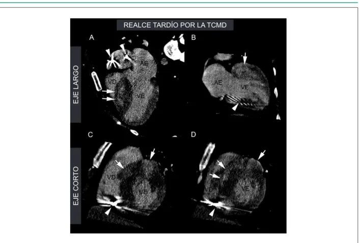 Fig. 1 - Realce tardío (RT) por la Tomografía Computarizada con 64 columnas de detectores (TCMD)