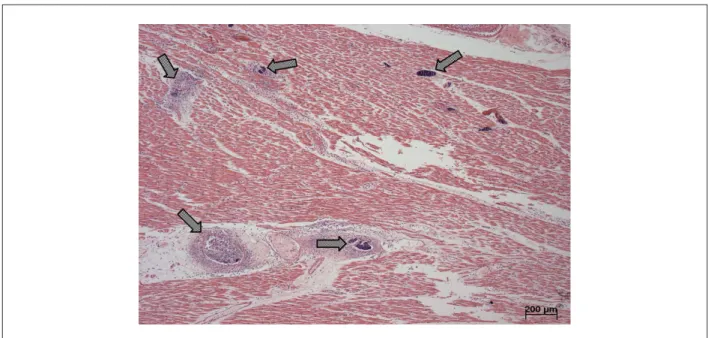 Fig. 6 - Corte histológico do miocárdio. mostrando vasos ocupados por trombos sépticos constituídos por bactérias e células inlamatórias
