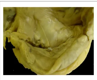 Figure 3 -  Cross-section of valve commissure, showing lesion with raw surface. 