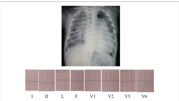Figure 2 -The echocardiogram shows the aortic coarctation in the isthmus region, after the emergence of the left subclavian artery, measuring 3-mm in diameter in  suprasternal view, in A; the subpulmonary ventricular septal defect, measuring 10 mm in diame