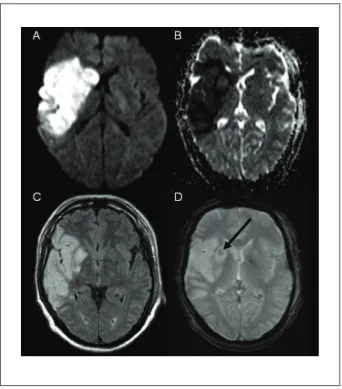 Figure 2 - MRI Stroke-protocol.(A) DWI, (B) ADC map, (C) FLAIR, (D), T2  weighted. The indings are compatible with a large ischemic lesion in the right  basal ganglia and right frontal, parietal and temporal lobes, territories of the  deep and supericial b