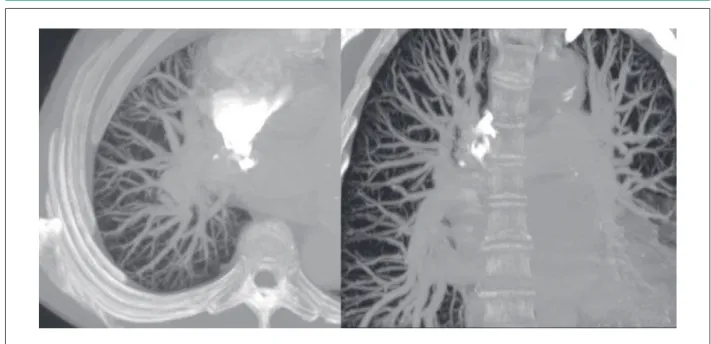 Figure  2  – Abdominal angio-CT images conirming the previous hepatic  indings with the presence of arteriovenous istula.