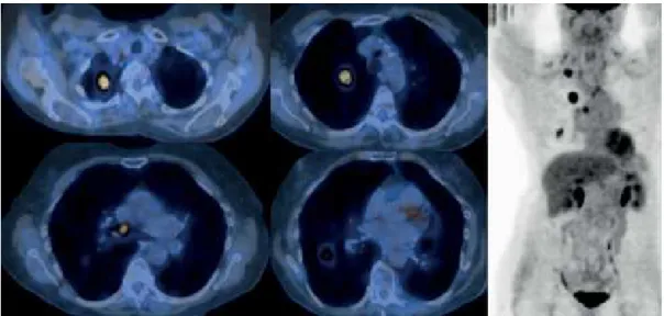 Figura 1 - PET/TC (esquerda) e PET (direita) torácicas realizadas para estadiamento de paciente do sexo  feminino, de 57 anos de idade, com diagnóstico de câncer de pulmão de células não pequenas