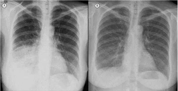 Figura 1 - Radiografia de tórax antes do tratamento com sirolimo (em A) e após 12 meses de tratamento 