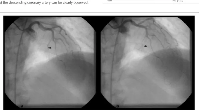 Figure 1 - Coronary angiography performed in a 56-year-old female patient that presented compression of the left anterior descending artery, with an 80% decrease in  vessel lumen diameter (arrow) at systole (A) and persistence of the phenomenon at diastole