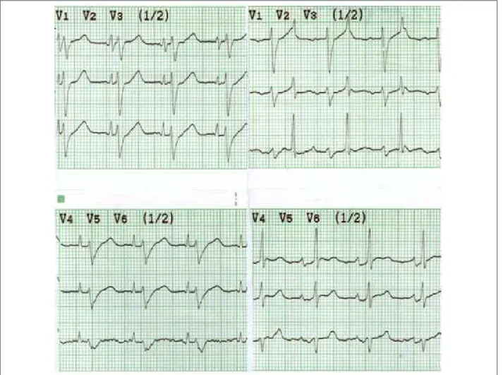 Figure 1 - On the left column, classic precordial leads showing the implanted heart beats and the native heart beats, with large QRS