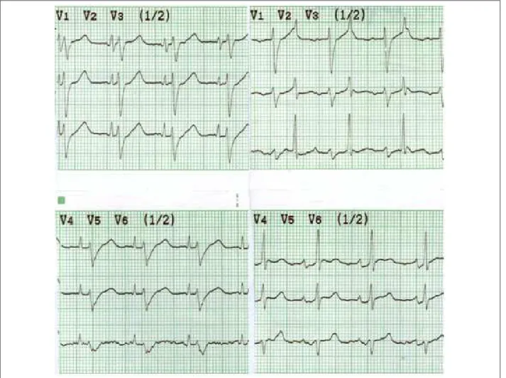 Fig. 1 - En la columna de la izquierda, derivaciones precordiales clásicas mostrando el primer latido del corazón implantado y el segundo del corazón nativo, con QRS  ensanchado