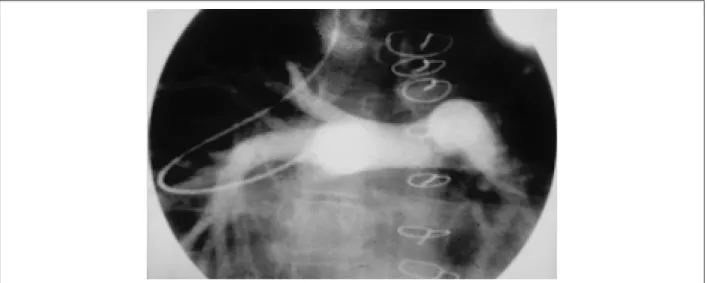 Fig. 2 - Rx de tórax en PA con la técnica convencional, con empleo de tubo prostético a la izquierda y a la derecha, con anastomosis directa entre las pulmonares