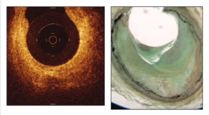 Figure 4 -  The thrombus produces a signal-rich structure with backscattering  on OCT