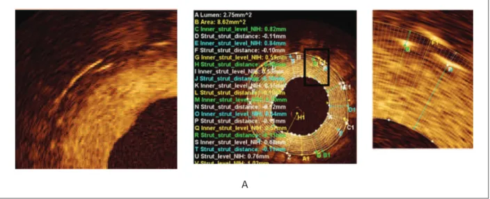 Fig. 5A - Imagen transversal de una región sobrepuesta con área luminal de 2,75 mm 2  y contorno externo del stent de 8.62 mm 2 