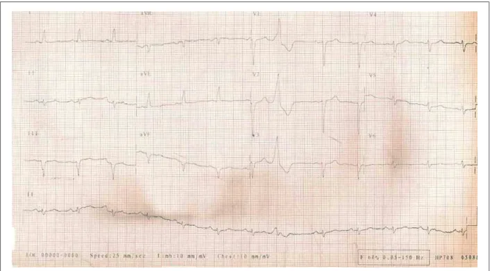 Figure 1 - ECG. Sinus rhythm, left axis deviation, electrically inactive area in the inferior wall.
