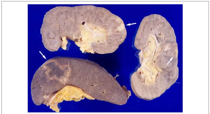 Figure 4 - Macroscopic aspect of the kidneys and spleen, demonstrating areas of recent infarction on the cross-sectional surfaces (arrows).