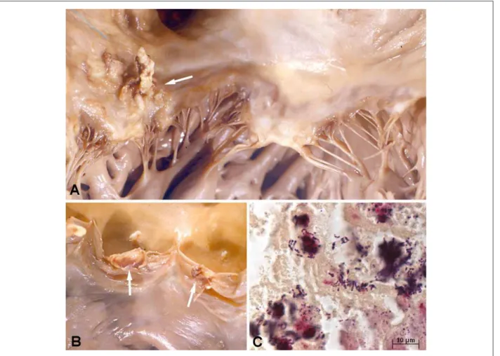 Fig. 3 -  Endocarditis infecciosa. Vegetaciones en la porción atrial de la cúspide posterior de la válvula mitral (panel A, lecha) y en el borde libre de las semilunares  de la válvula pulmonar (panel B, lechas)