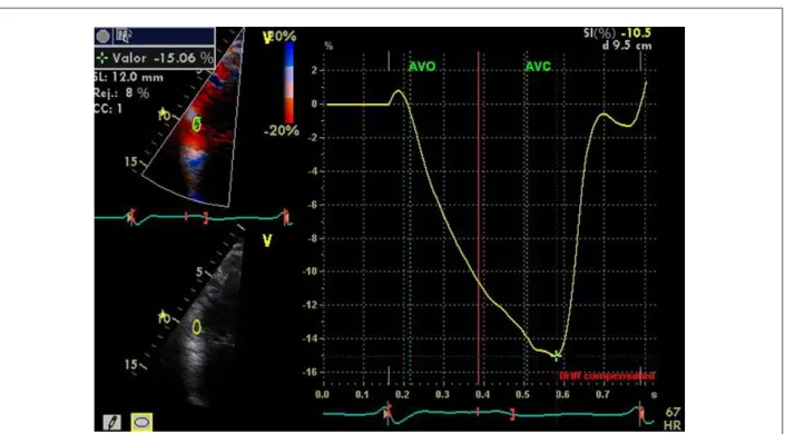 Figure 3 - Measurement of the strain in the basal segment of the free wall of the right ventricle