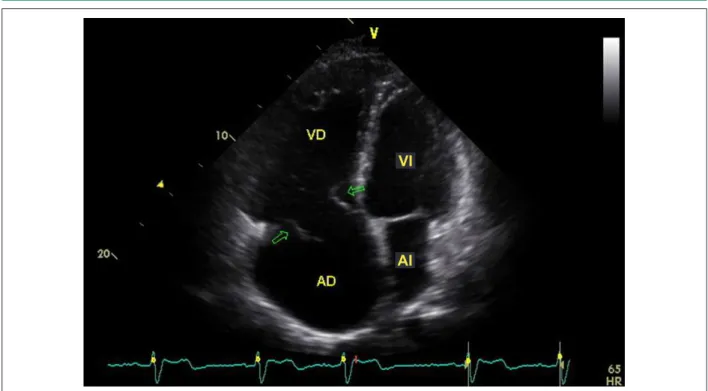 Fig. 2 - Corte apical de 4 cámaras al ecocardiograma, evidenciando regurgitación tricúspide importante al Doppler en colores.