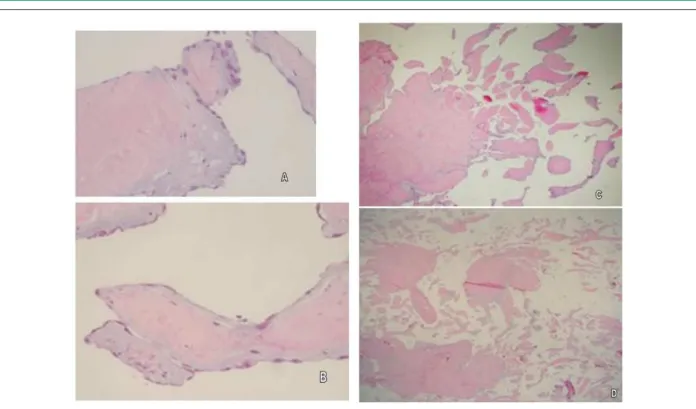 Figure 2 - Anatomopathological analysis. Papillary Fibroelastoma. Hematoxylin-eosin (HE) stain