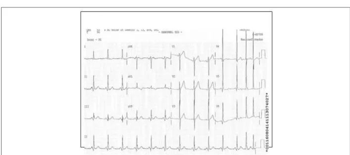 Figure 1B - Second postoperative day showing sinus rhythm with ST segment elevation in leads V1 to V6 and DI and aVL.