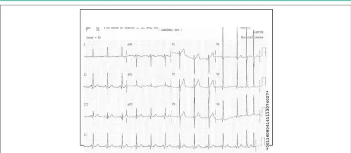 Fig. 1B -  Segundo día postoperatorio indicando ritmo sinusal con elevación del segmento ST de V1 a V6 y DI y AVL.