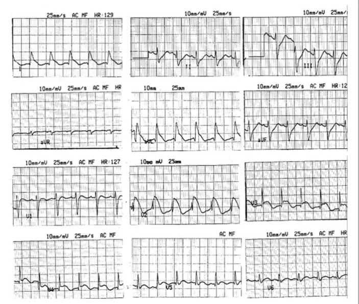 Figure 1 - Admission surface electrocardiogram.    Case No. 2.  ST segment elevation in precordial (V2-V5) and limb leads (DI-AVL)
