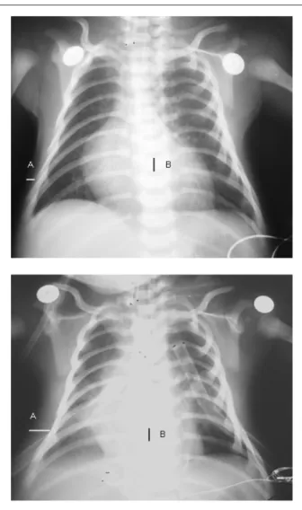 Figure 1 - Delimitation of parameters for radiologic index. In A, the thickness  of the subcutaneous tissue is measured and, in B, the vertebral height, which  is utilized as index factor, is measured