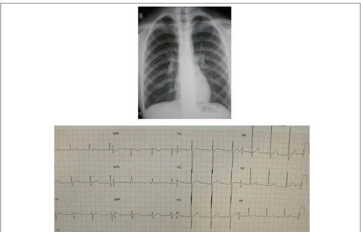 Fig. 1 -  Radiografía de tórax que revela área cardíaca normal y trama vascular pulmonar ligeramente pronunciada en los hilos