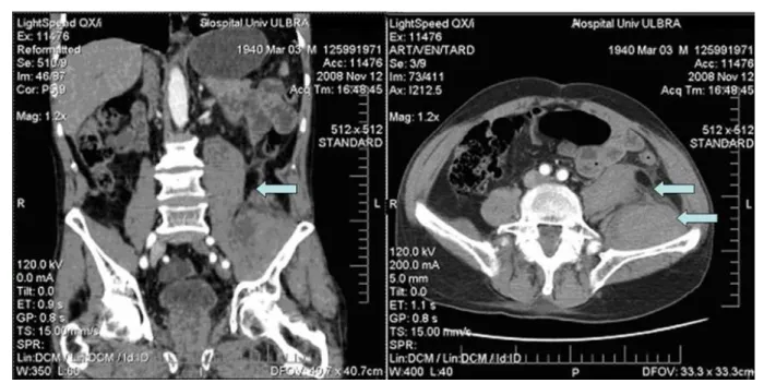 Figure 1 - Contrast-enhanced computed tomography of the abdomen showing diffuse enlargement of the left iliac and psoas muscles in sagittal and cross-sectional  views